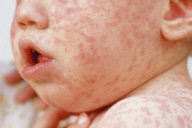 CDC warns of measles surge and decline in vaccinations as Trump nominates vaccine-skeptic RFK Jr to head health