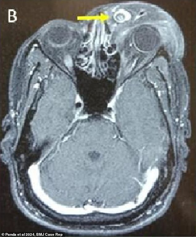 I was blinded and left with horrific facial deformity after a parasite began breeding in my eyeball