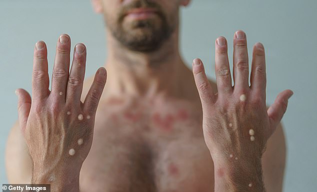 Urgent warning as ultra-deadly mpox strain spreads cross-country – with new case detected 160 miles from the last
