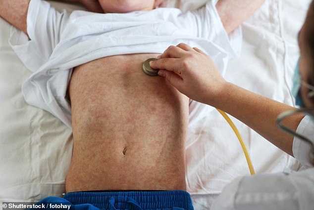 Nine US states on red alert as measles kills one and infects untold number
