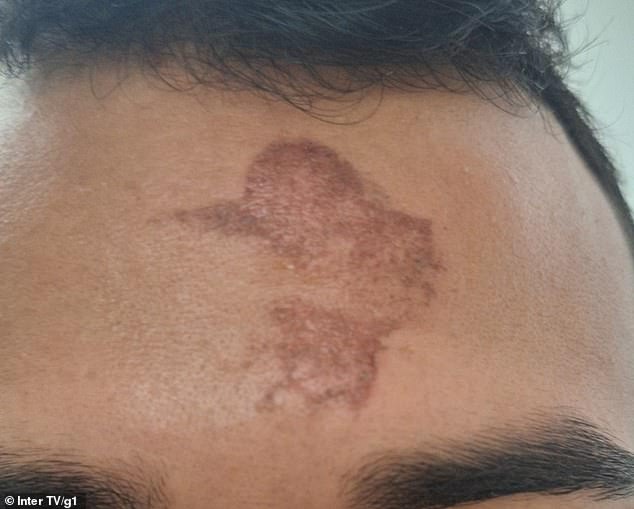 Mystery as churchgoers’ foreheads are BURNED after receiving mark of the cross on Ash Wednesday