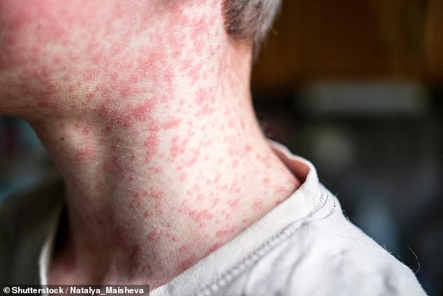 Health chiefs’ urgent warning over record highs of deadly measles – are YOU in a hotspot?