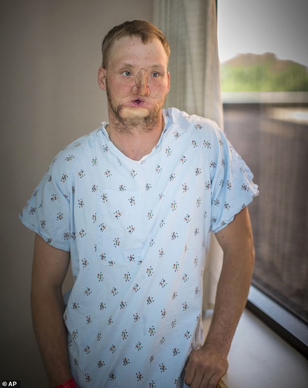 A gunshot left me without half a face… but a groundbreaking transplant changed my life
