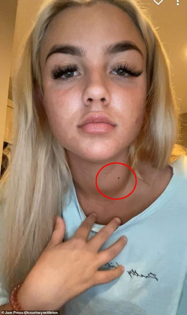 Young woman who was diagnosed with thyroid cancer at just 20 claims GPs dismissed years of symptoms as ‘laziness’