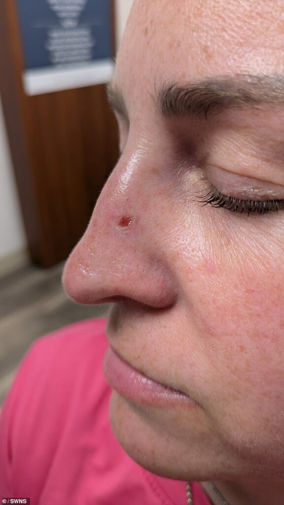 Mother-of-four, 43, reveals subtle mark she thought was just dry skin – but it was skin cancer: ‘I ALWAYS wore sunscreen’