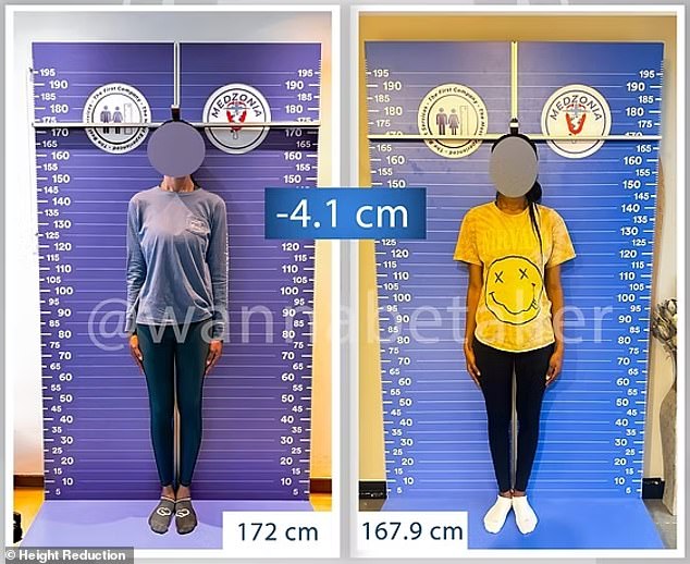 Women are flying to Turkey for brutal LEG SHORTENING operations to make themselves more petite