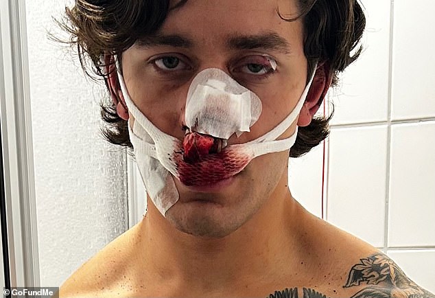 New York model horrifically disfigured after protecting two women from knifeman while vacationing in Germany